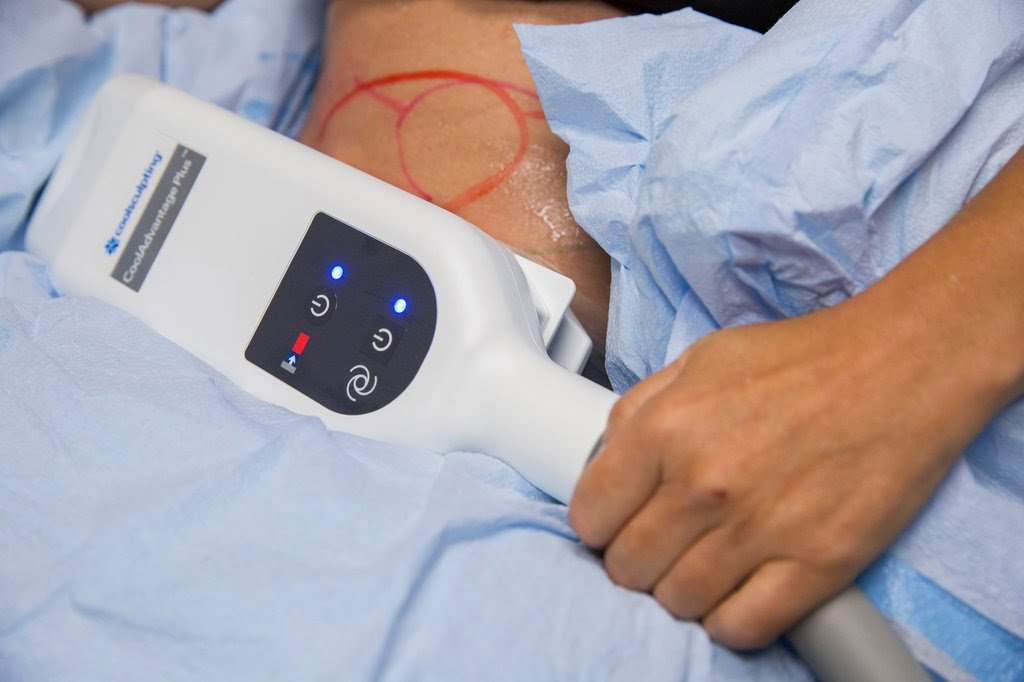 An Overview of the Popular Best at Home Coolsculpting Machine