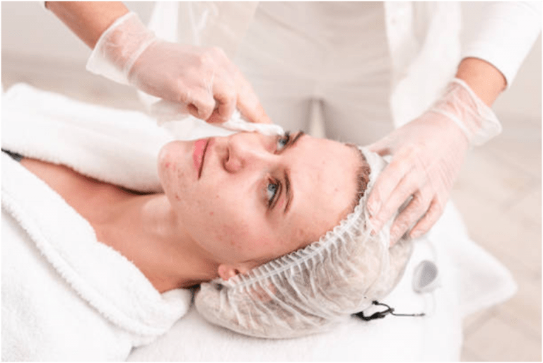 How Does Acne Scar Treatment Work? in 2021